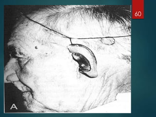 Extraoral 
Prostheses -- 
Ear 
60 
 