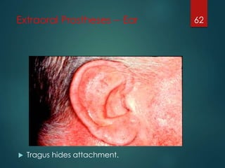 Extraoral Prostheses -- Ear 
 Tragus hides attachment. 
62 
 