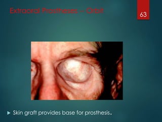 Extraoral Prostheses -- Orbit 
 Skin graft provides base for prosthesis. 
63 
 