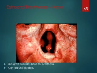 Extraoral Prostheses -- Nose 
 Skin graft provides base for prosthesis. 
 Alar tag undesirable. 
65 
 