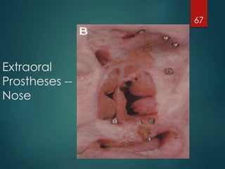 Extraoral 
Prostheses -- 
Nose 
67 
 