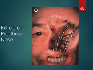 Extraoral 
Prostheses -- 
Nose 
68 
 