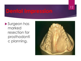 Dental Impression 
 Surgeon has 
marked 
resection for 
prosthodonti 
c planning. 
12 
 