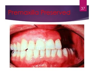 Premaxilla Preserved 
37 
 