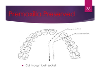 Premaxilla Preserved 
 Cut through tooth socket 
38 
 