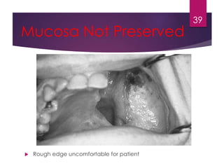 Mucosa Not Preserved 
 Rough edge uncomfortable for patient 
39 
 
