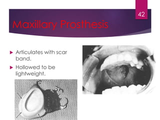 Maxillary Prosthesis 
 Articulates with scar 
band. 
 Hollowed to be 
lightweight. 
42 
 