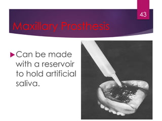 Maxillary Prosthesis 
Can be made 
with a reservoir 
to hold artificial 
saliva. 
43 
 