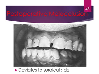Postoperative Malocclusion 
Deviates to surgical side 
48 
 