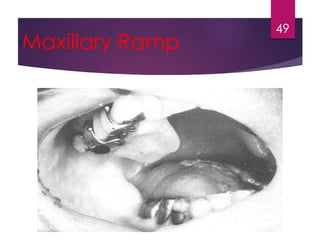 Maxillary Ramp 
49 
 