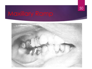 Maxillary Ramp 
50 
 