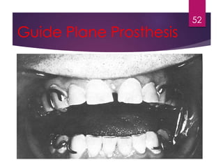 Guide Plane Prosthesis 
52 
 