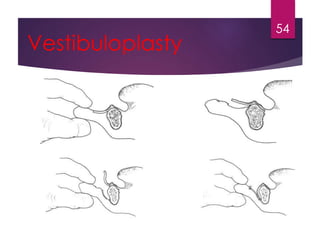 Vestibuloplasty 
54 
 