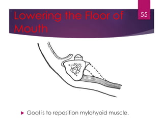 Lowering the Floor of 
Mouth 
 Goal is to reposition mylohyoid muscle. 
55 
 
