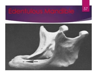 Edentulous Mandible 57 
 