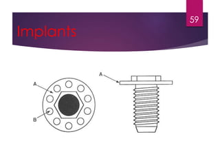 Implants 
59 
 