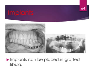 Implants 
Implants can be placed in grafted 
fibula. 
64 
 