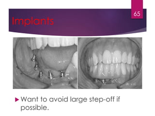 Implants 
Want to avoid large step-off if 
possible. 
65 
 