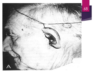 Extraoral 
Prostheses -- Ear 
68 
 