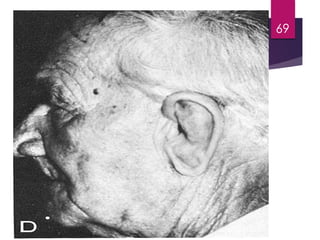 Extraoral 
Prostheses -- Ear 
69 
 