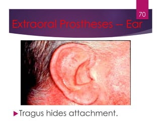 Extraoral Prostheses -- Ear 
Tragus hides attachment. 
70 
 