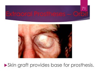 71 
Extraoral Prostheses -- Orbit 
Skin graft provides base for prosthesis. 
 