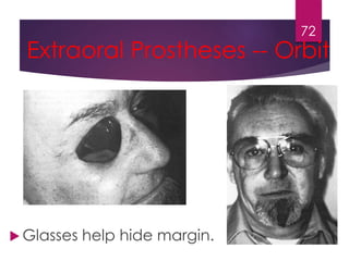 Extraoral Prostheses -- Orbit 
 Glasses help hide margin. 
72 
 