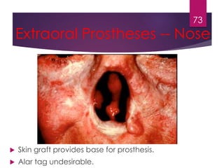 Extraoral Prostheses -- Nose 
 Skin graft provides base for prosthesis. 
 Alar tag undesirable. 
73 
 