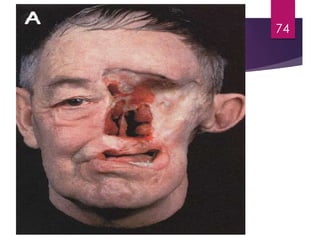 Extraoral 
Prostheses -- Nose 
74 
 