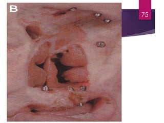 Extraoral 
Prostheses -- Nose 
75 
 