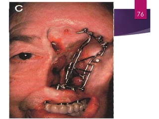 Extraoral 
Prostheses -- Nose 
76 
 