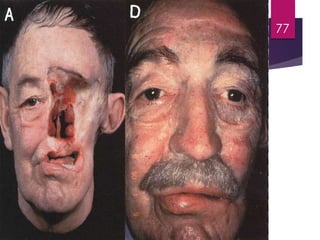 Extraoral 
Prostheses -- Nose 
77 
 