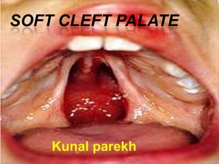 SOFT CLEFT PALATE




    Kunal parekh
 