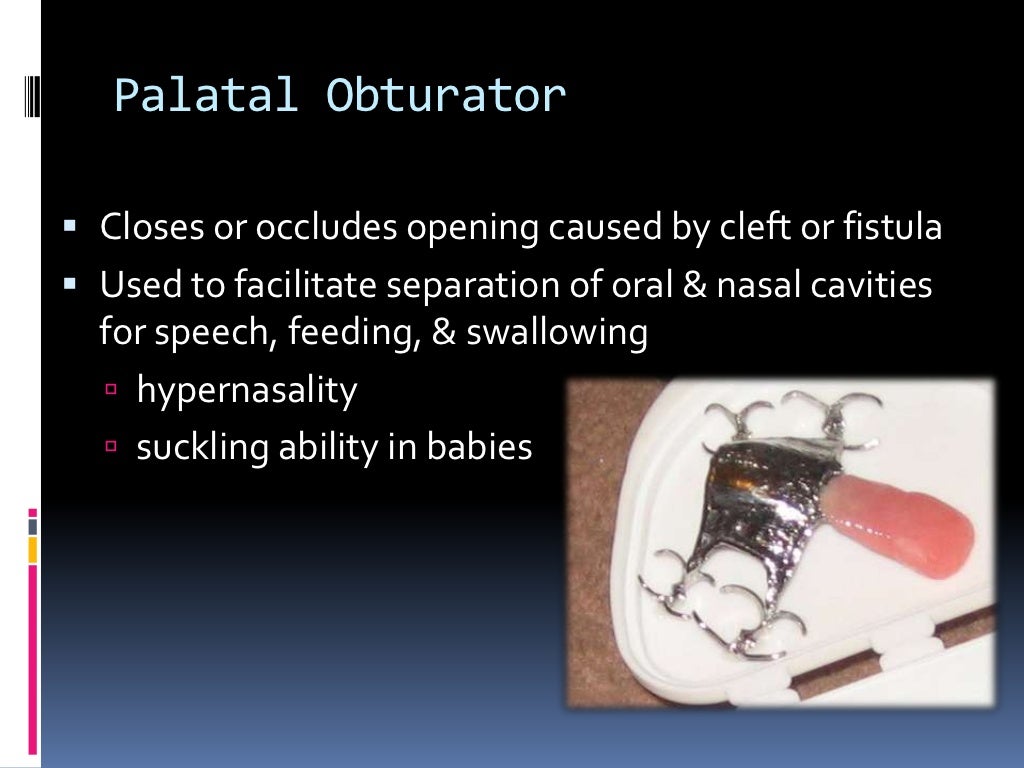Maxillofacial prosthesis of soft cleft palate