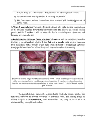 Maxillary Ramps Maxillofacial prosthetics theory and practice 2011 | PDF