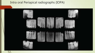 Light Radiograph Iopa Maxillofacial radiology | PPTX