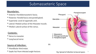 Submasseter Space Maxillofacial space infection and management.pptx