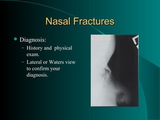 Nasal Fractures
 Diagnosis:
  – History and physical
    exam.
  – Lateral or Waters view
    to confirm your
    diagnosis.
 