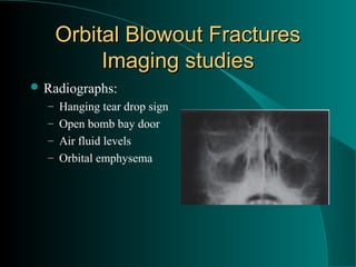 Orbital Blowout Fractures
        Imaging studies
 Radiographs:
  – Hanging tear drop sign
  – Open bomb bay door
  – Air fluid levels
  – Orbital emphysema
 