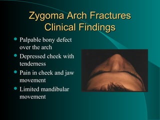 Zygoma Arch Fractures
        Clinical Findings
 Palpable bony defect
  over the arch
 Depressed cheek with
  tenderness
 Pain in cheek and jaw
  movement
 Limited mandibular
  movement
 