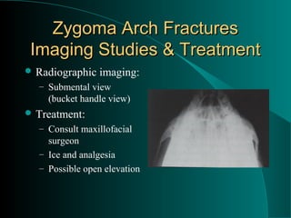 Zygoma Arch Fractures
 Imaging Studies & Treatment
 Radiographic   imaging:
  – Submental view
    (bucket handle view)
 Treatment:
  – Consult maxillofacial
    surgeon
  – Ice and analgesia
  – Possible open elevation
 