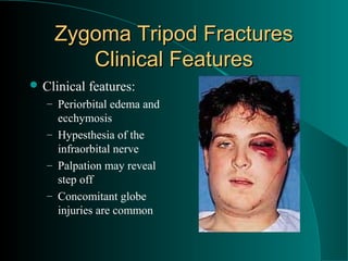 Zygoma Tripod Fractures
       Clinical Features
 Clinical   features:
   – Periorbital edema and
     ecchymosis
   – Hypesthesia of the
     infraorbital nerve
   – Palpation may reveal
     step off
   – Concomitant globe
     injuries are common
 