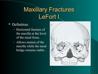 Maxillary Fractures
                 LeFort I
 Definition:
   – Horizontal fracture of
     the maxilla at the level
     of the nasal fossa.
   – Allows motion of the
     maxilla while the nasal
     bridge remains stable.
 