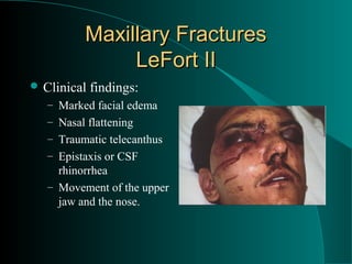 Maxillary Fractures
               LeFort II
 Clinical   findings:
   – Marked facial edema
   – Nasal flattening
   – Traumatic telecanthus
   – Epistaxis or CSF
     rhinorrhea
   – Movement of the upper
     jaw and the nose.
 