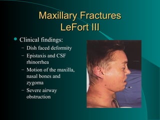 Maxillary Fractures
               LeFort III
 Clinical   findings:
   – Dish faced deformity
   – Epistaxis and CSF
     rhinorrhea
   – Motion of the maxilla,
     nasal bones and
     zygoma
   – Severe airway
     obstruction
 