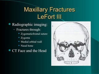 Maxillary Fractures
                  LeFort III
 Radiographic        imaging:
  – Fractures through:
          Zygomaticfrontal suture
          Zygoma
          Medial orbital wall
          Nasal bone
 CT   Face and the Head
 