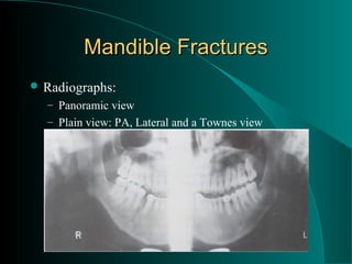 Mandible Fractures
 Radiographs:
  – Panoramic view
  – Plain view: PA, Lateral and a Townes view
 