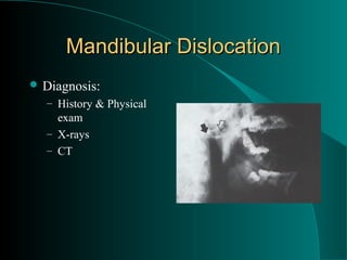 Mandibular Dislocation
 Diagnosis:
  – History & Physical
    exam
  – X-rays
  – CT
 