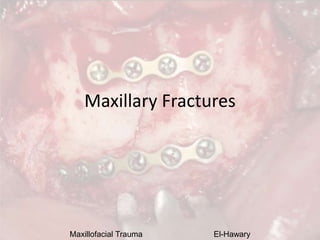 Maxillofacial Trauma El-Hawary
Maxillary Fractures
 