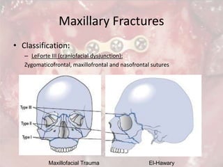Maxillofacial Trauma El-Hawary
Maxillary Fractures
• Classification:
– LeForte III (craniofacial dysjunction):
Zygomaticof...